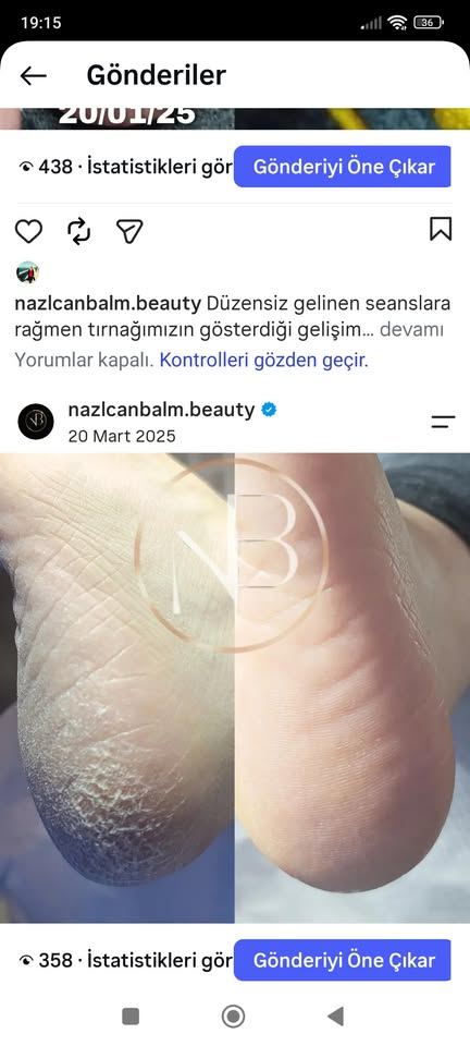Topuk Bakım Uygulaması gerçek çalışma görseli